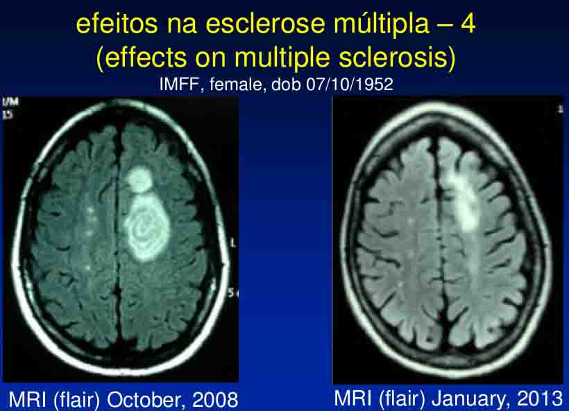 Multipla skleroza